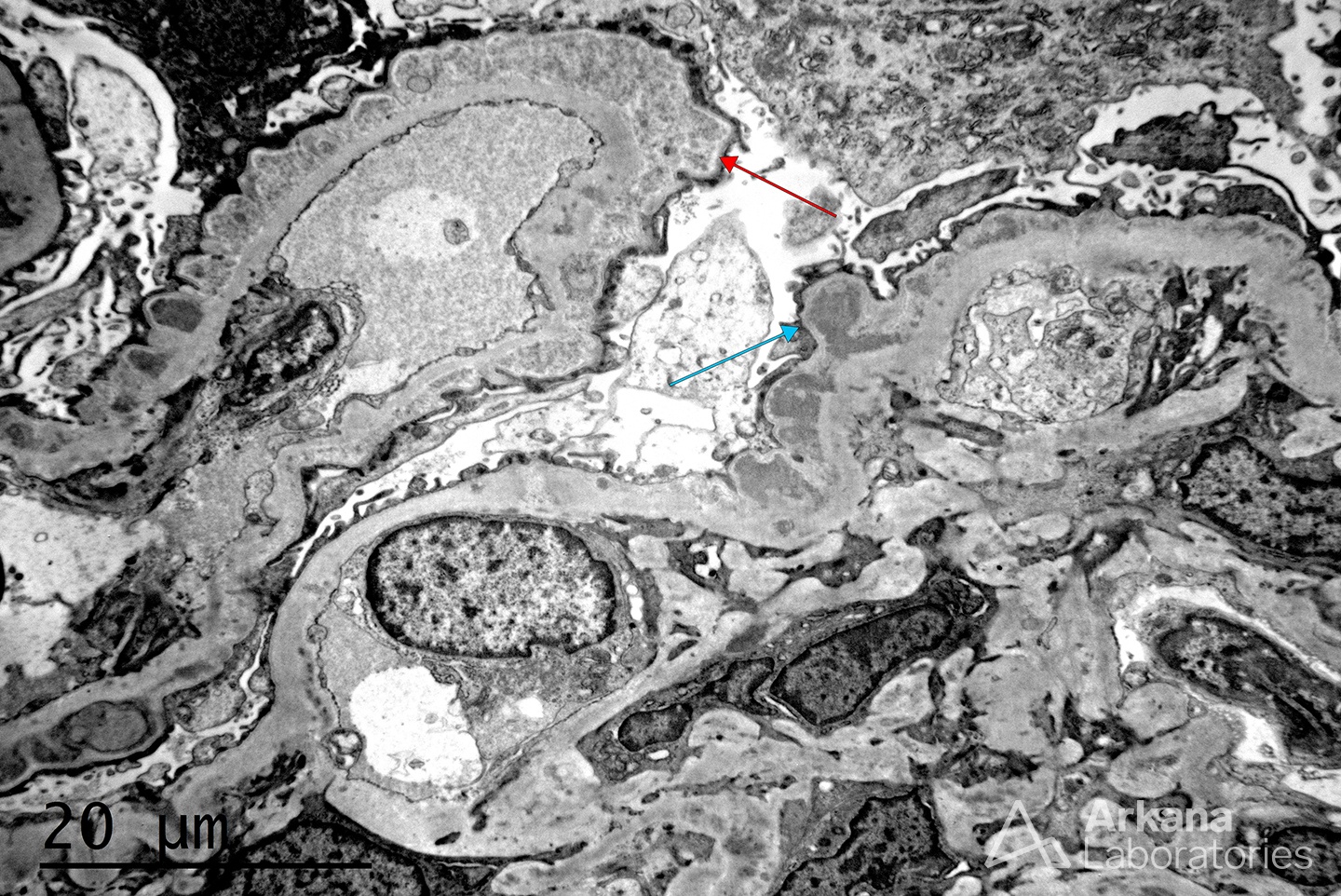 persistent proteinuria, membranous glomerulopathy