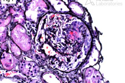 Crescentic Glomerulonephritis with IgA Deposits