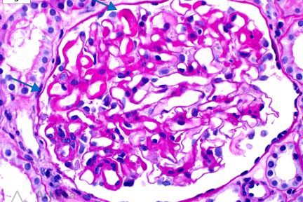 necrotizing lesions, glomeruli, large subendothelial immune deposits