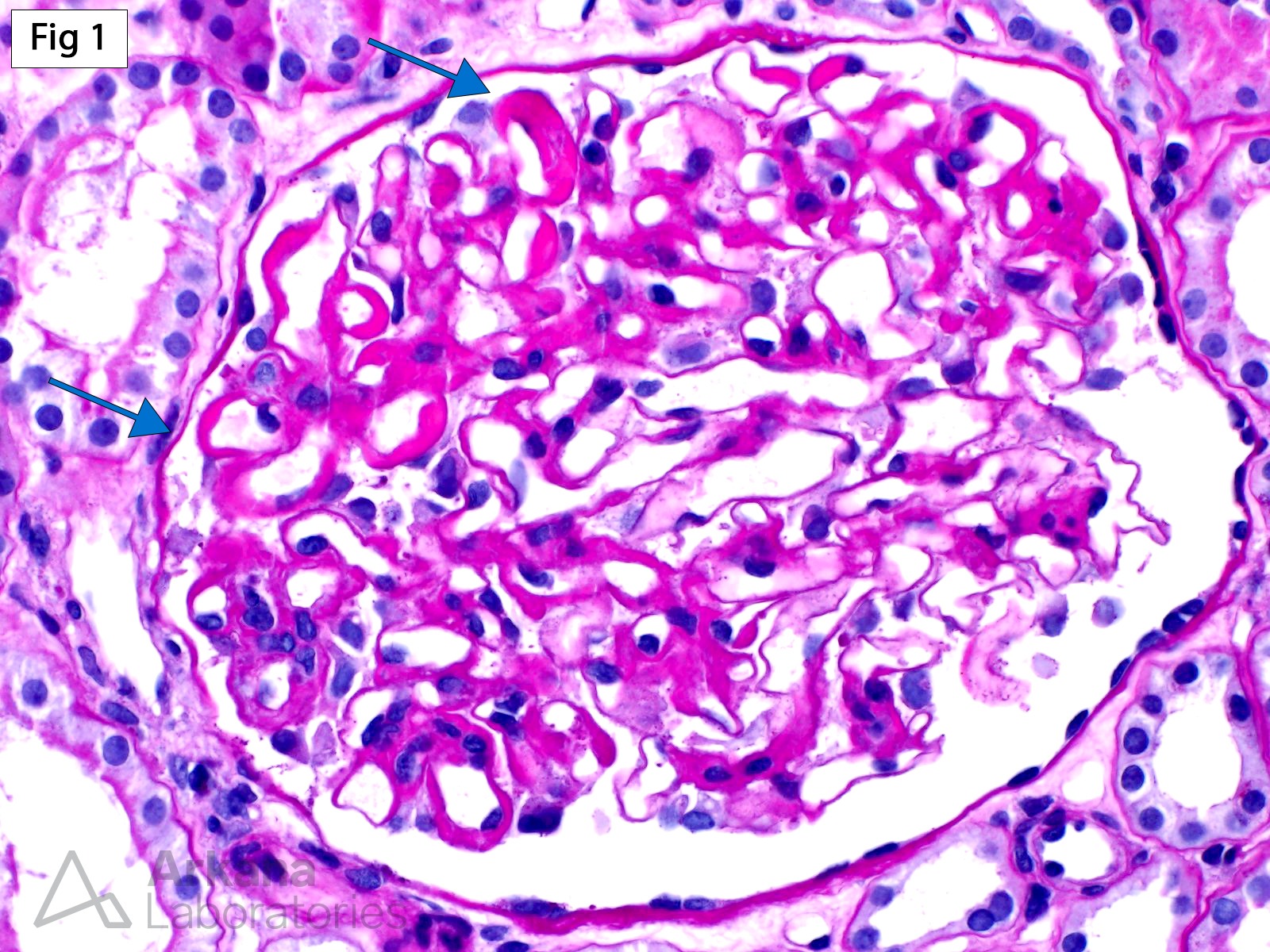 necrotizing lesions, glomeruli, large subendothelial immune deposits