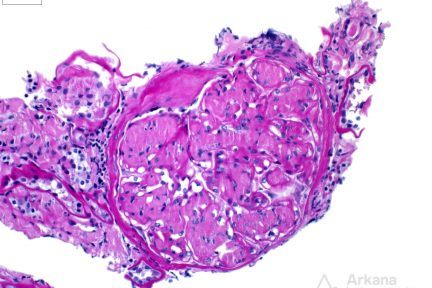 LECT2 Amyloidosis, tubulointerstitial and vascular deposition of a PAS-pale