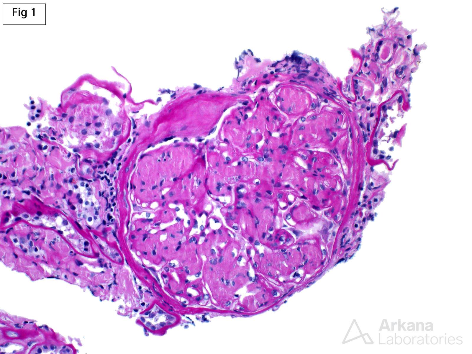 LECT2 Amyloidosis, tubulointerstitial and vascular deposition of a PAS-pale