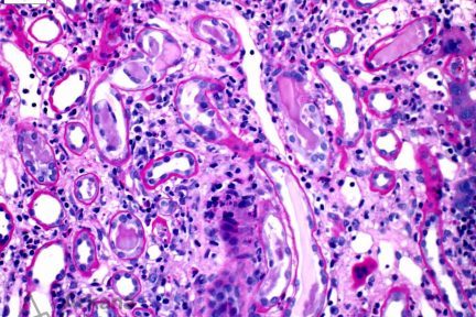 PAS-pale, focally fractured tubular casts with associated cellular reaction