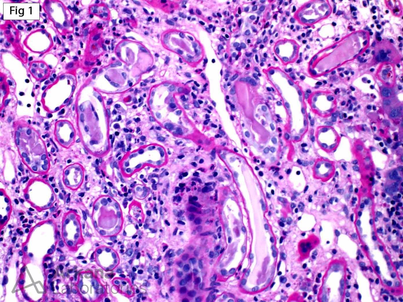 PAS-pale, focally fractured tubular casts with associated cellular reaction