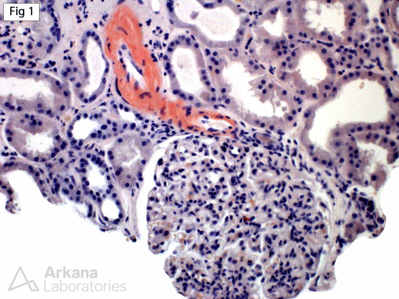 AL Amyloidosis