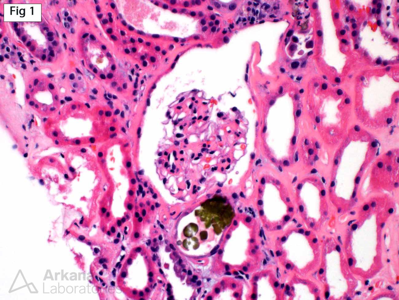 stained calcium deposits