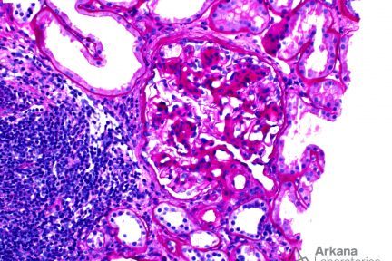 FSGS Tip Lesion