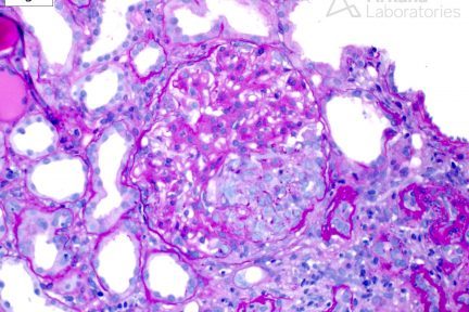 Crescentic Fibrillary Glomerulopathy