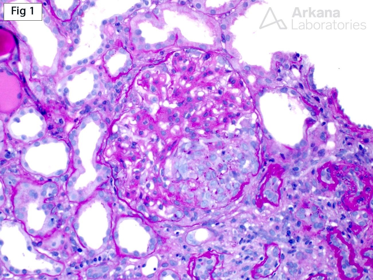 Crescentic Fibrillary Glomerulopathy