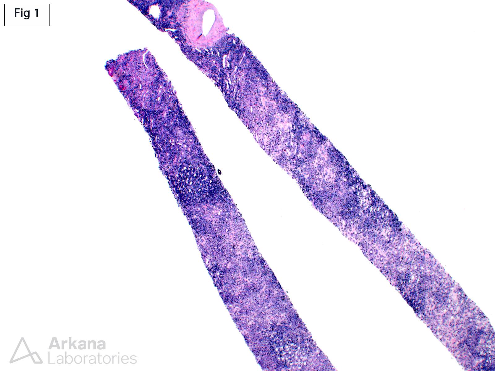 Granulomatous Interstitial Nephritis in CLL