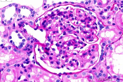 Focal Segmental Glomerulosclerosis (FSGS)