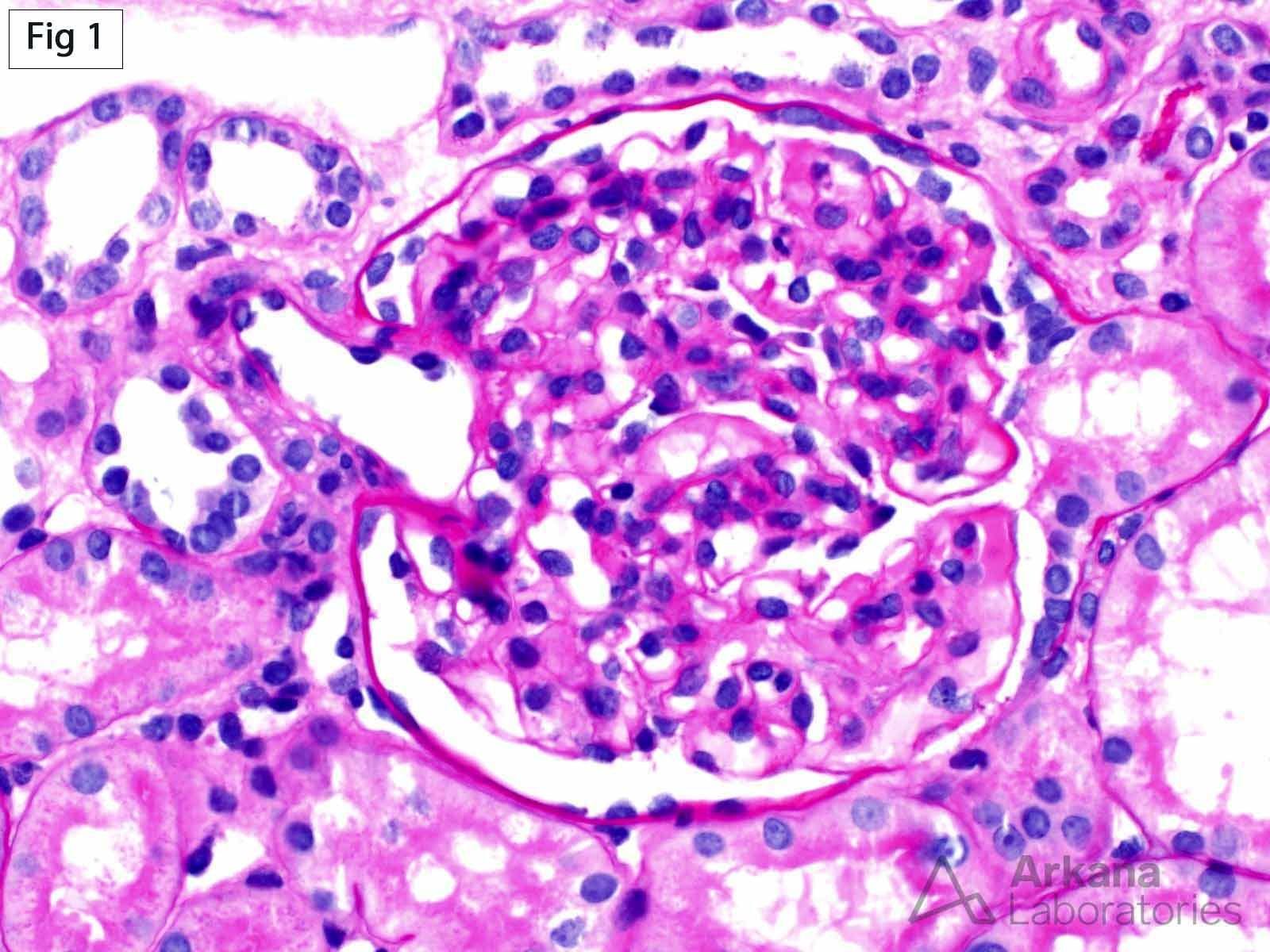 Focal Segmental Glomerulosclerosis (FSGS)