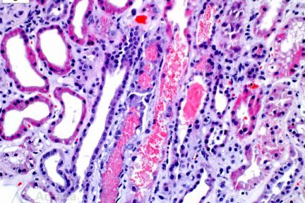 Intravascular Hemolysis