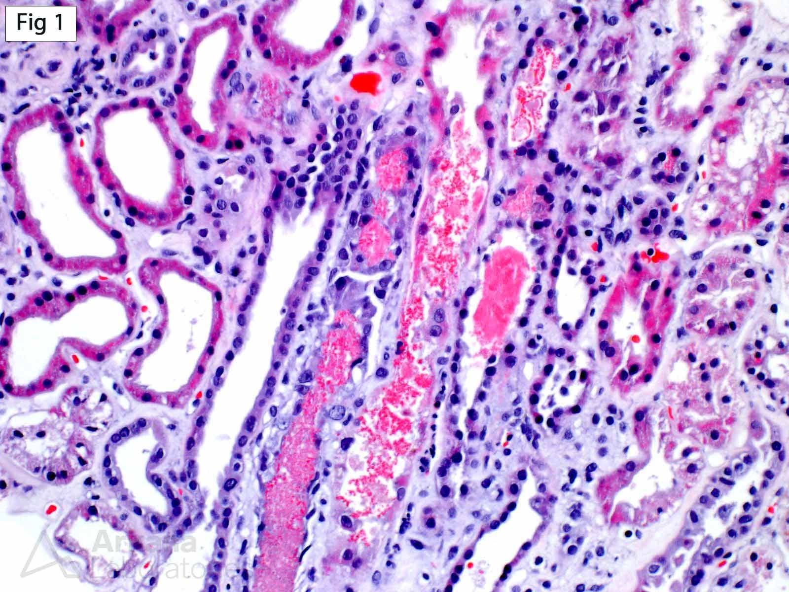 Intravascular Hemolysis