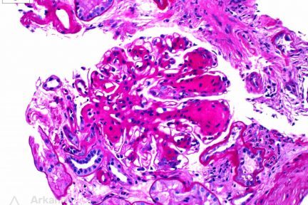 severe mesangial matrix expansion with frequent large nodule formation, Diabetic Glomerulosclerosis