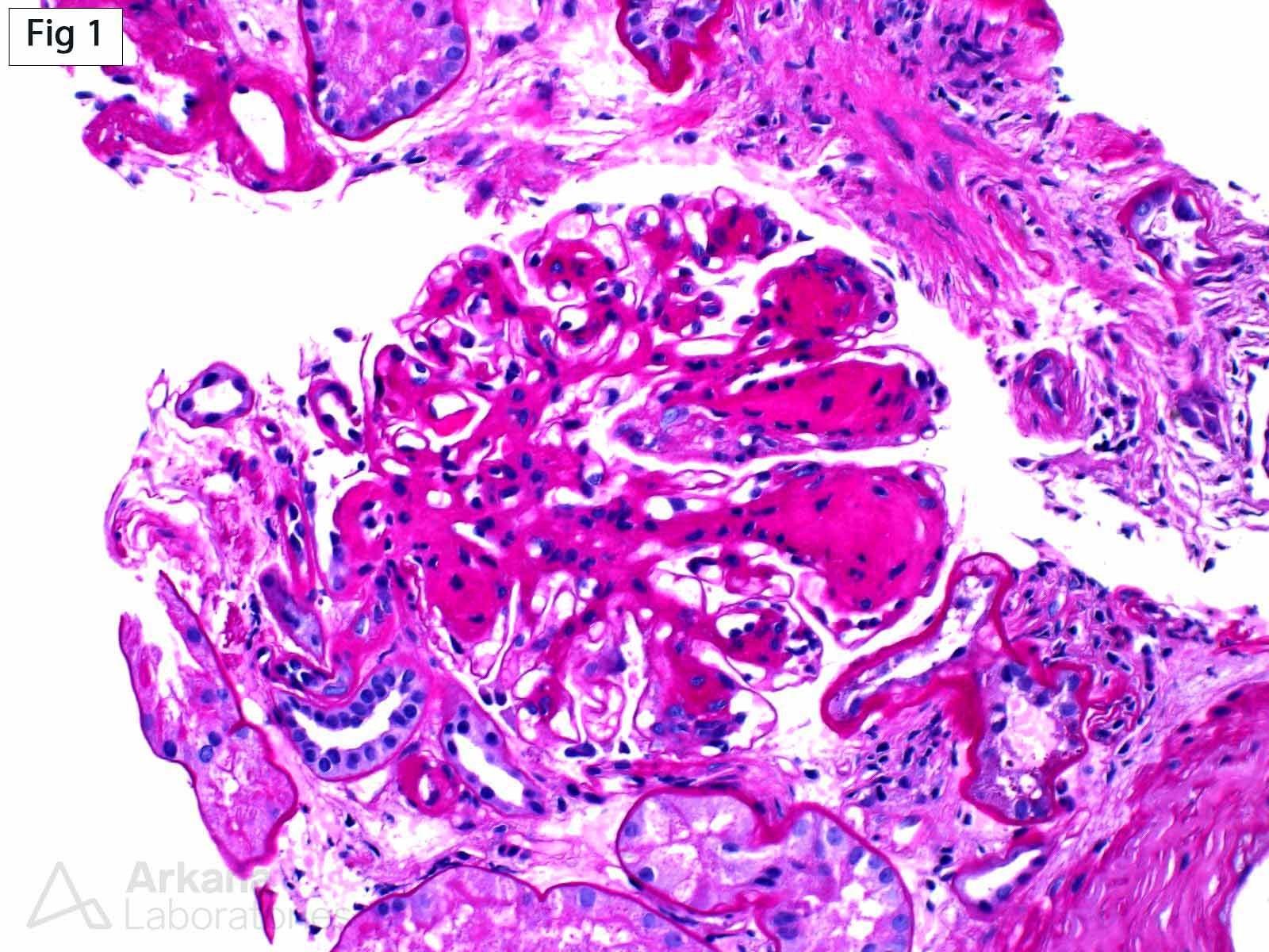 severe mesangial matrix expansion with frequent large nodule formation, Diabetic Glomerulosclerosis