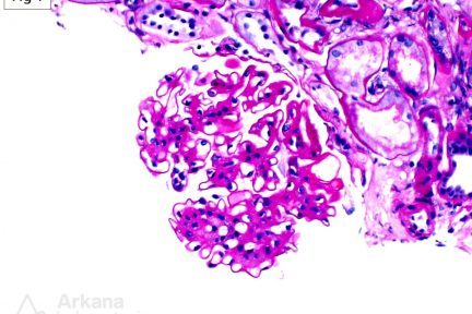 Smoking-Related Glomerulopathy