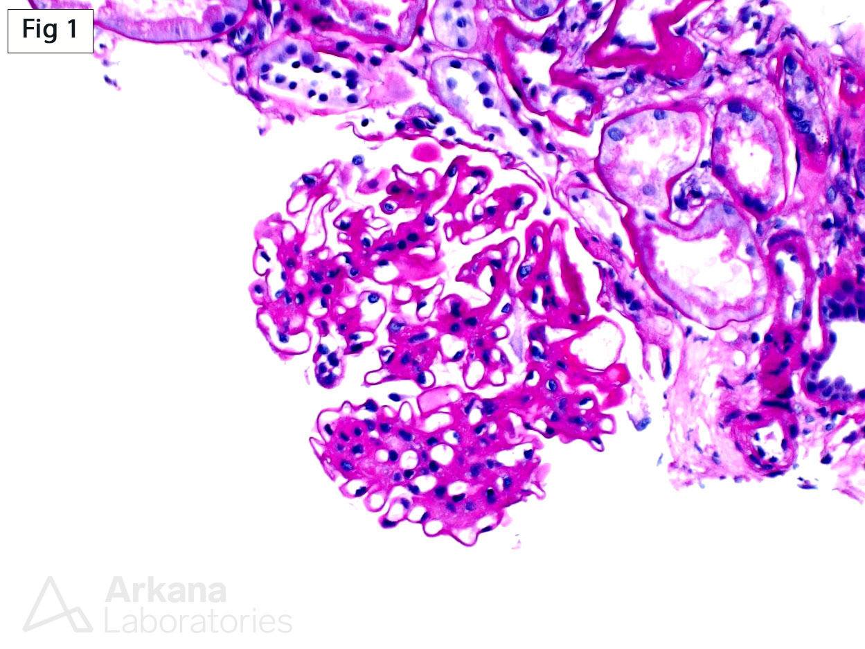 Smoking-Related Glomerulopathy