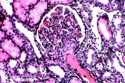 Thrombotic Microangiopathy