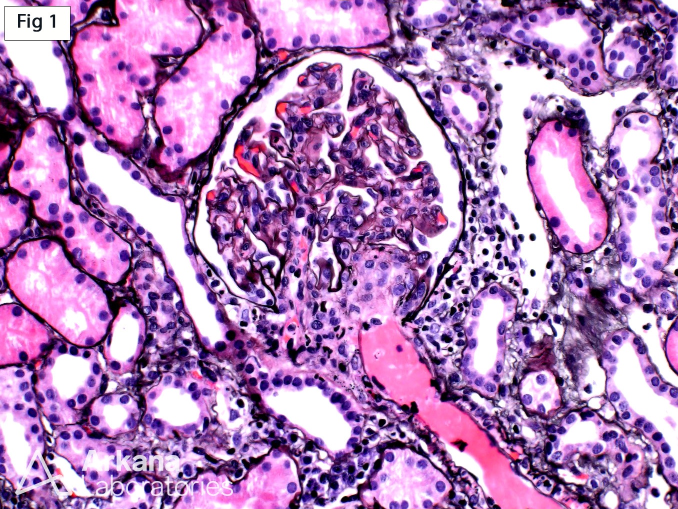 Thrombotic Microangiopathy