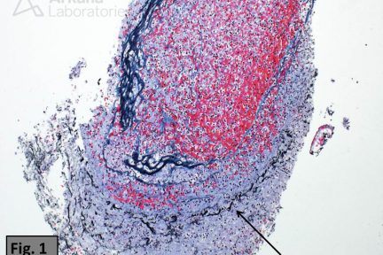 Arterial Thromboemboli