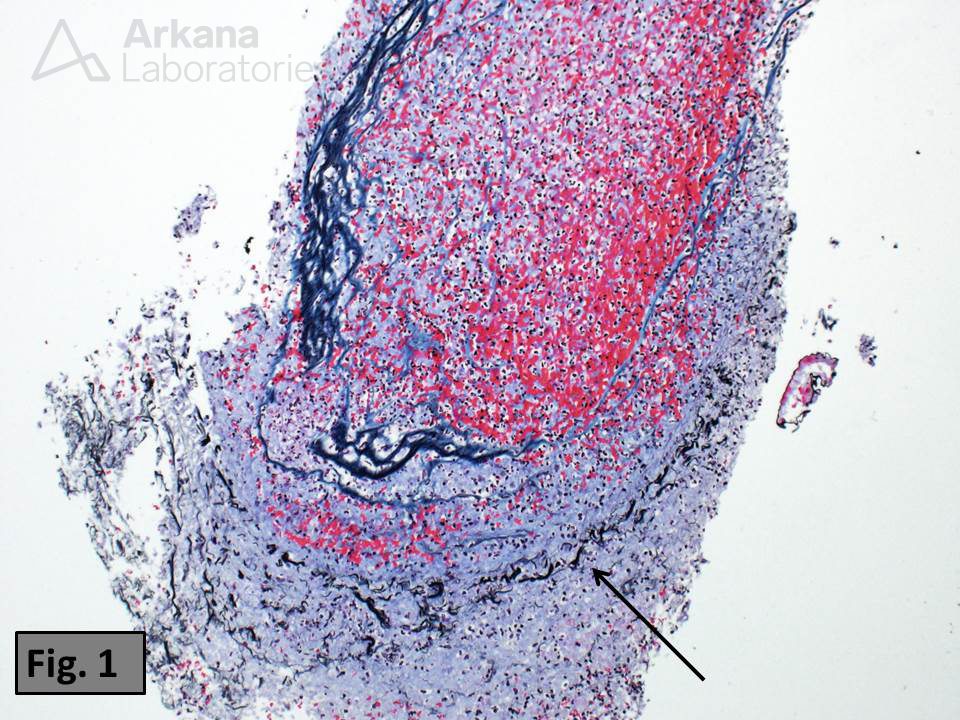 Arterial Thromboemboli