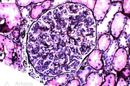 Proliferative Glomerulonephritis with Monoclonal IgG Deposits