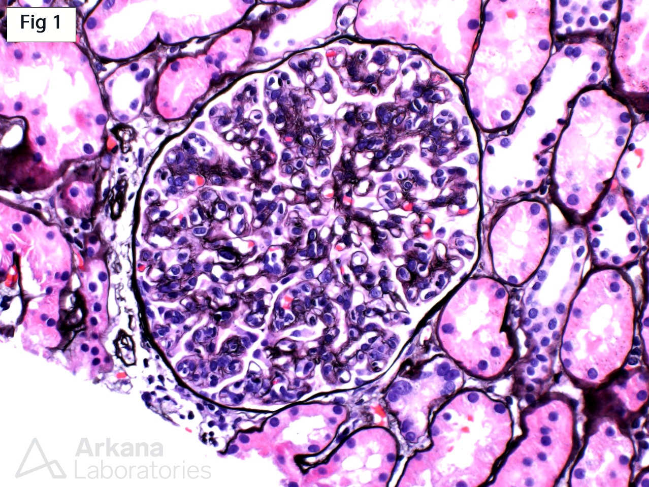 Proliferative Glomerulonephritis with Monoclonal IgG Deposits