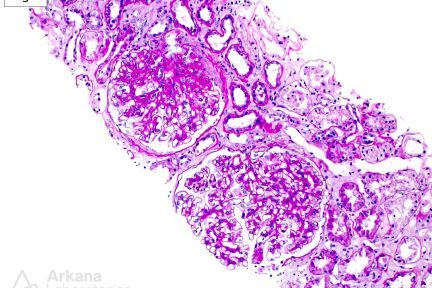 Obesity-Related Glomerulopathy