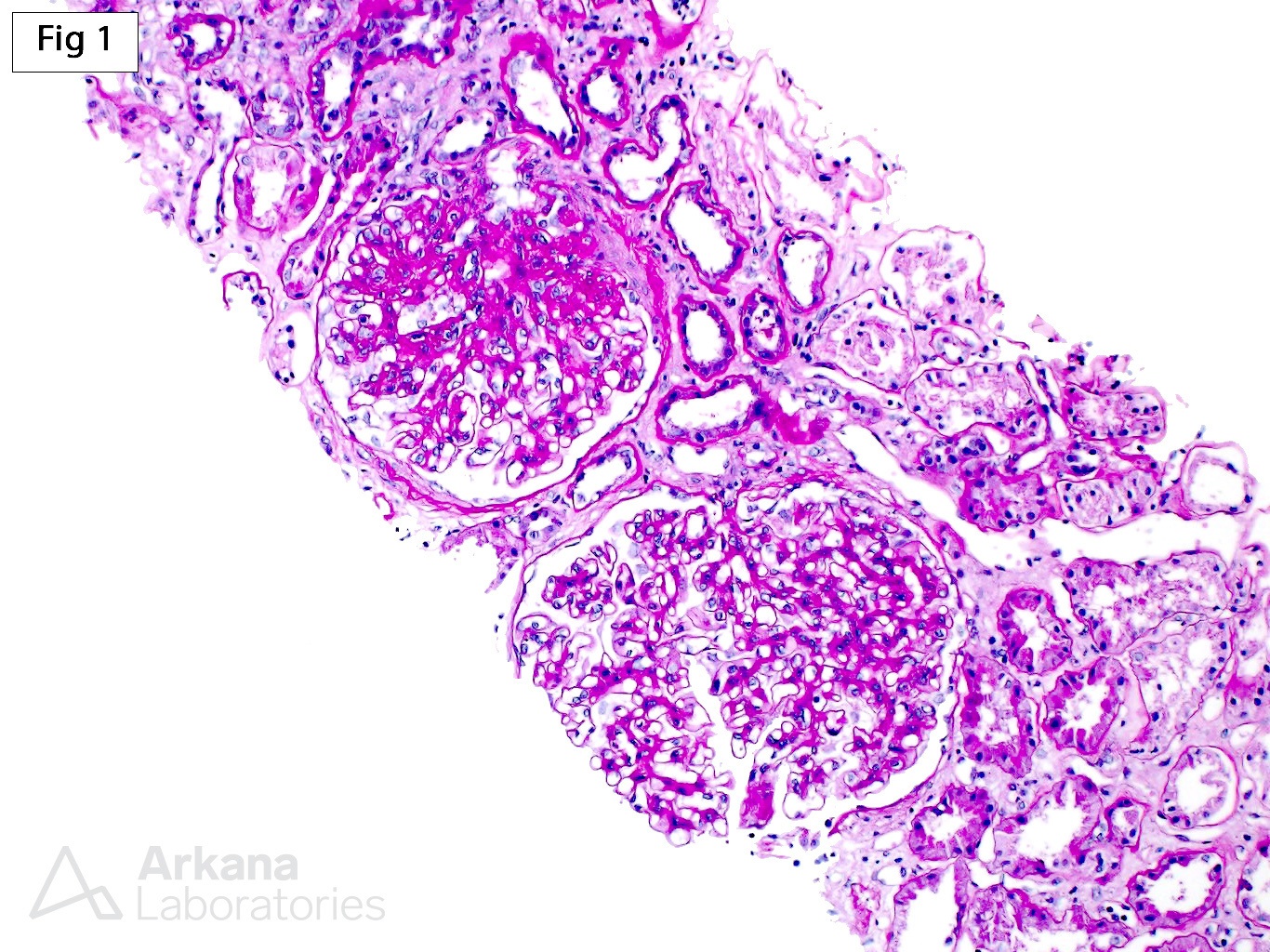 Obesity-Related Glomerulopathy