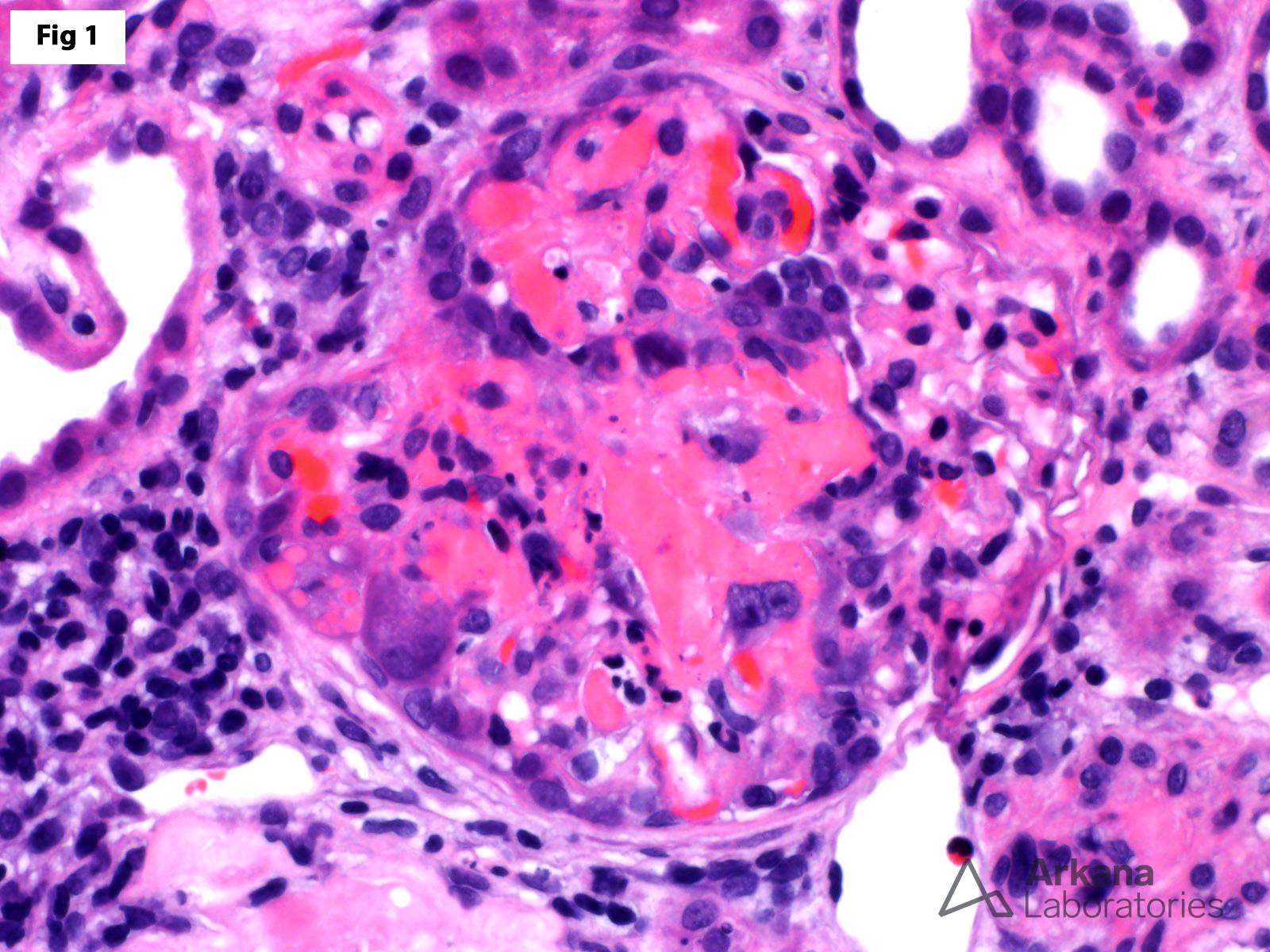 Medullary Angiitis in renal biopsy