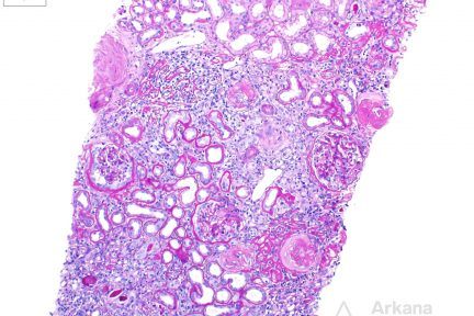 Polyomavirus Nephropathy in Native Kidney