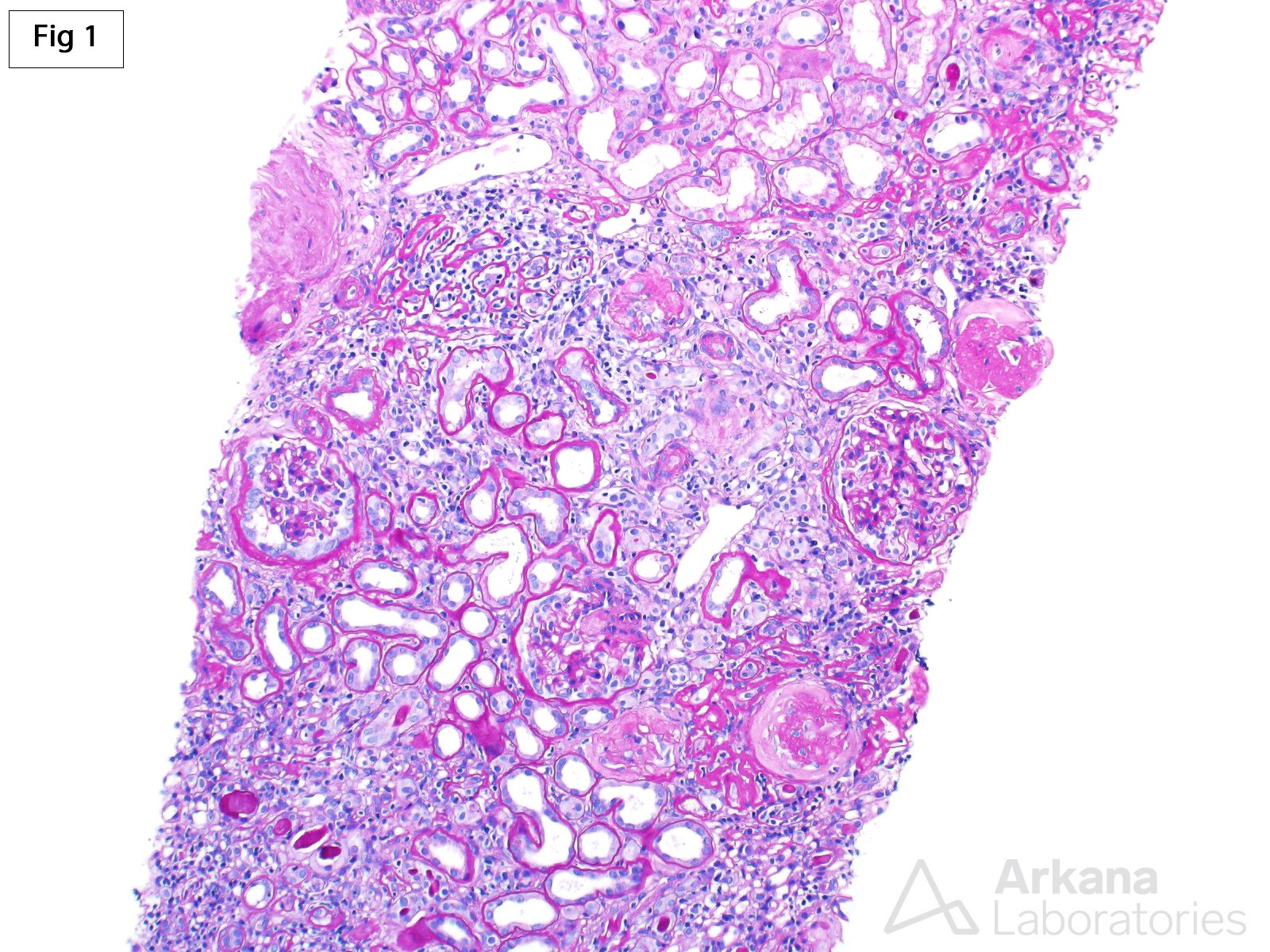 Polyomavirus Nephropathy in Native Kidney