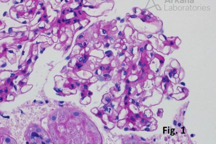 IgA nephropathy in renal biopsy from Arkana Laboratories