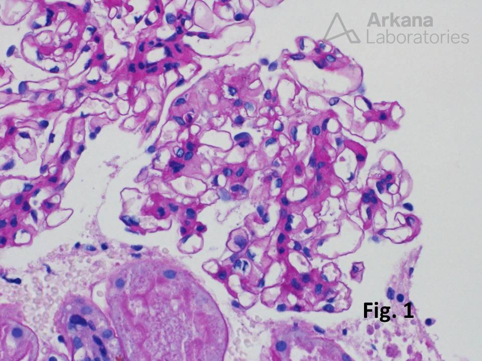 IgA nephropathy in renal biopsy from Arkana Laboratories