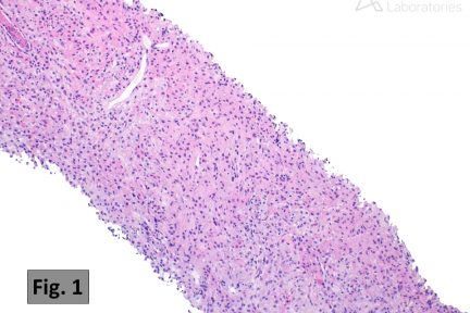 Malakoplakia, renal pathology, arkana laboratories