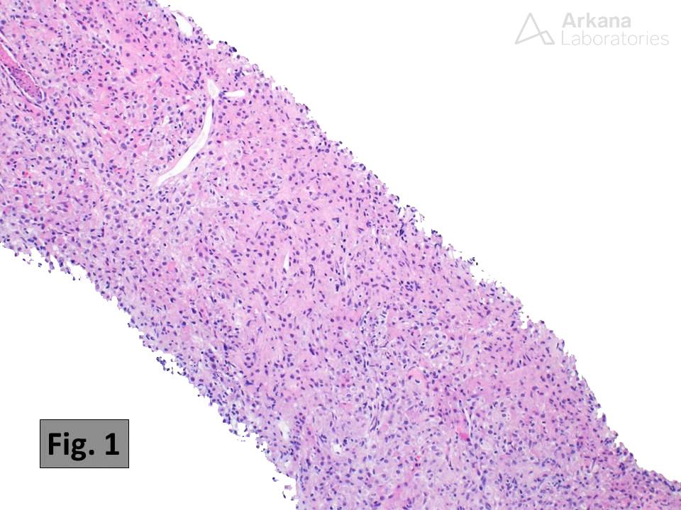 Malakoplakia, renal pathology, arkana laboratories