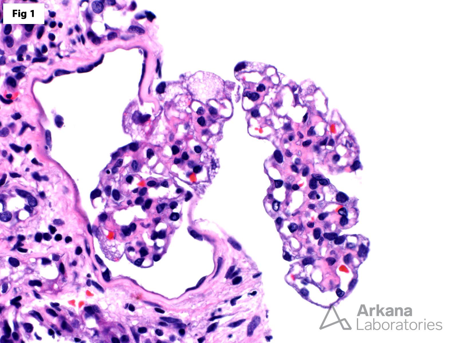 Fabry Disease