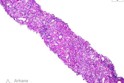 Megalocytic Interstitial Nephritis