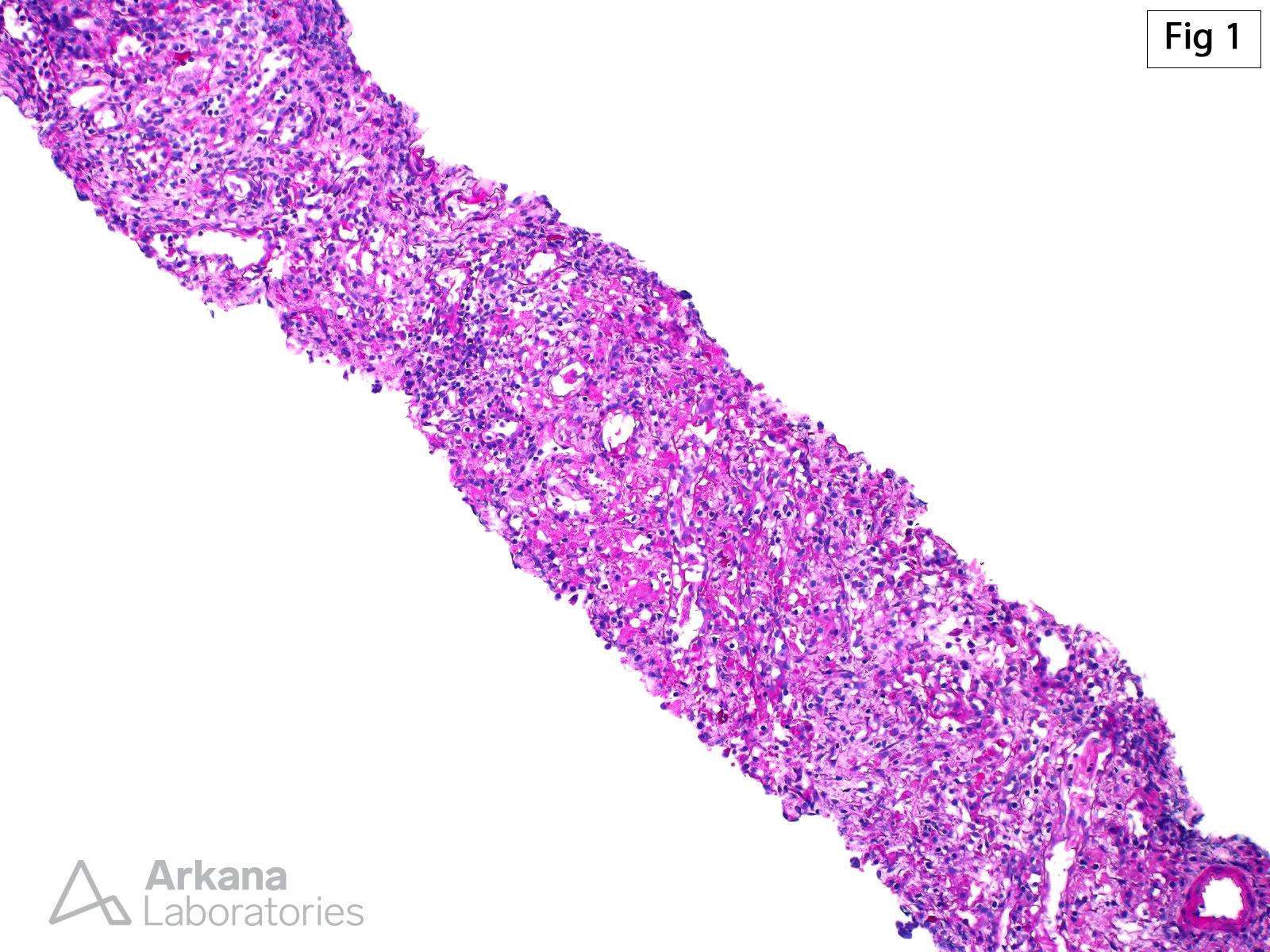 Megalocytic Interstitial Nephritis