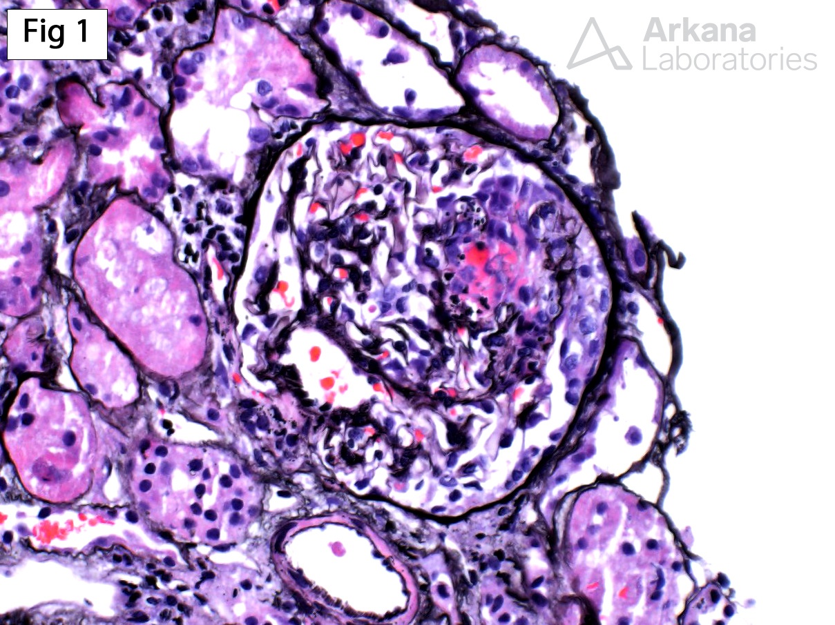 Crescentic Glomerulonephritis with IgA Deposits