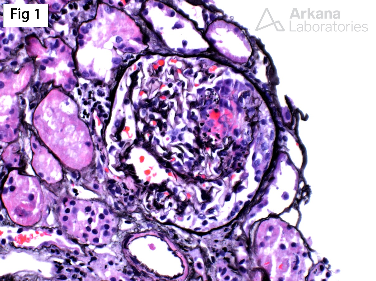 Crescentic Glomerulonephritis with IgA Deposits