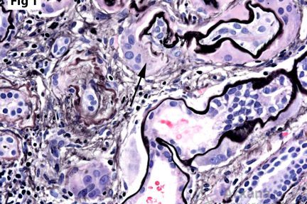 Peritubular Giant Cells, giant cell reaction surrounding many of the tubules