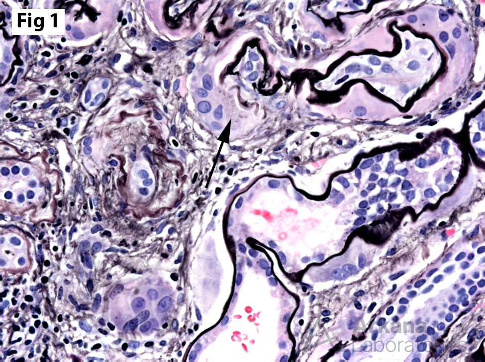 Peritubular Giant Cells, giant cell reaction surrounding many of the tubules