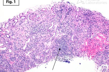 Chronic Active T Cell-Mediated Rejection, renal cortex