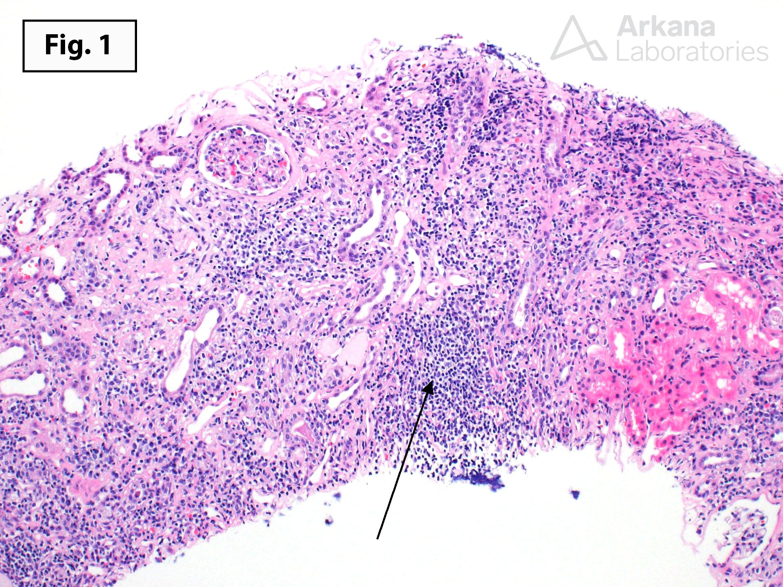 Chronic Active T Cell-Mediated Rejection, renal cortex