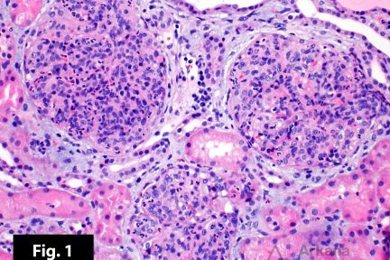 Acute Post-Infectious Glomerulonephritis