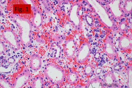 Adenovirus, interstitial hemorrhage and edema