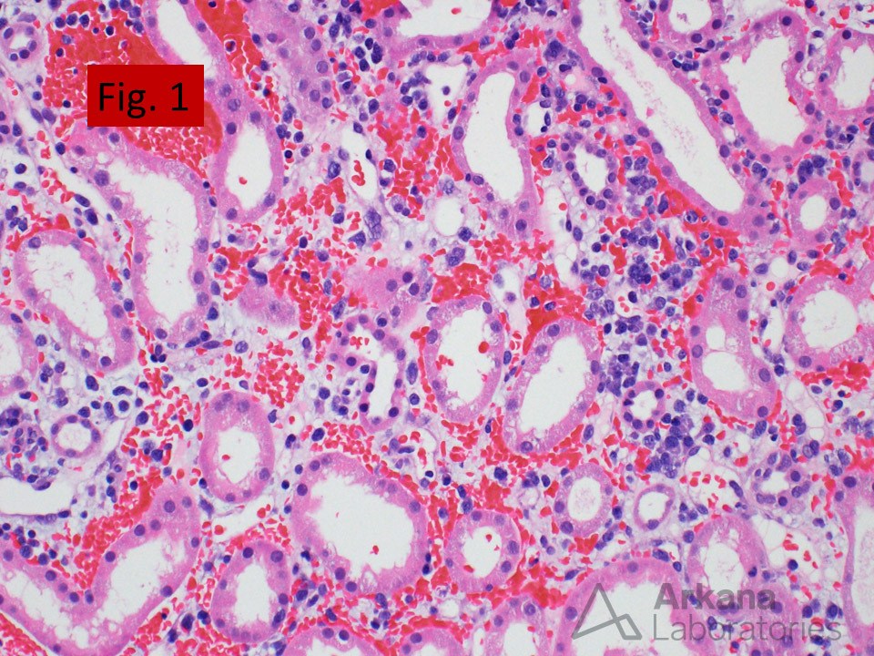 Adenovirus, interstitial hemorrhage and edema