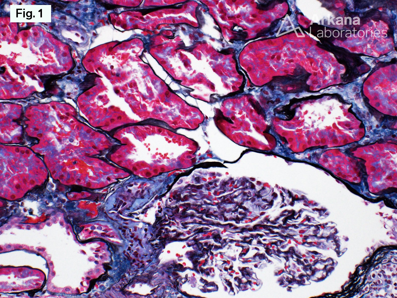 Ask-Upmark, normal renal biopsy, arkana laboratories